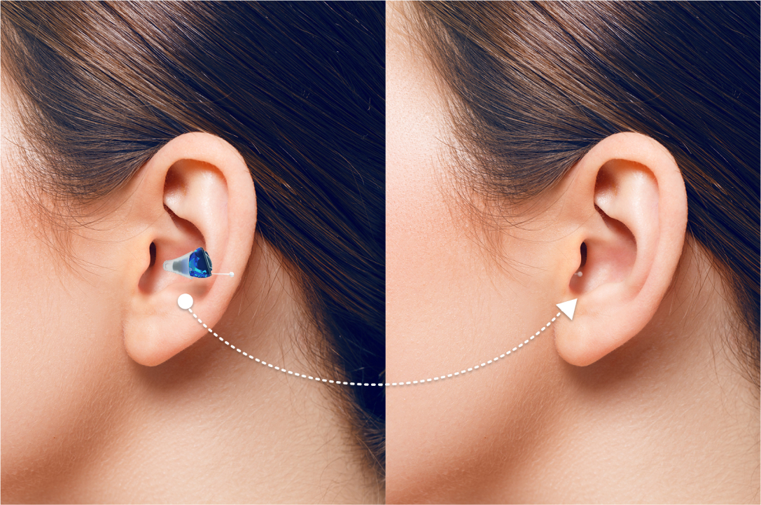 Aperçu appareil auditif intra-auriculaire dans l'oreille