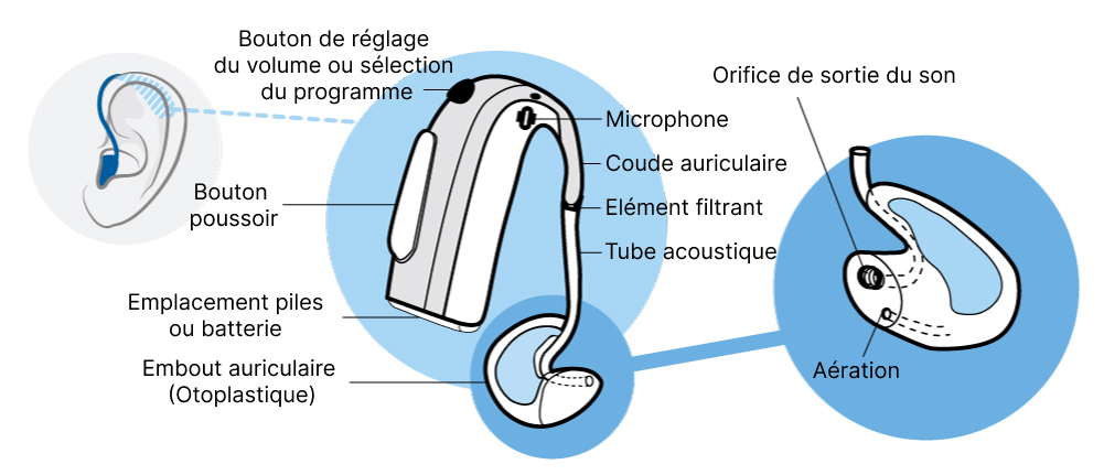 Schéma détaillé fonctionnement appareil auditif BTE