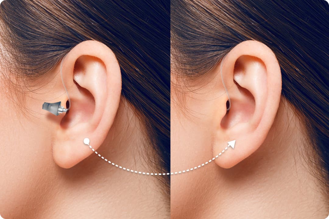 Aperçu appareil auditif contour d'oreille